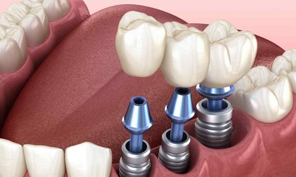 Протезирование зубов на имплантах в Саратове